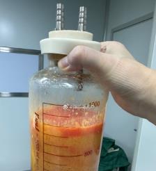 青海水动力吸脂手术要做多久？